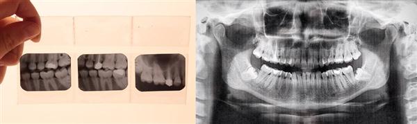 Dental Bitewing X-Ray vs Panoramic X-Ray
