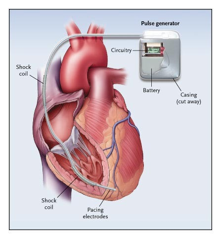 Custom Wires & Cable Assembly for Implantable Cardioverter defibrillators 