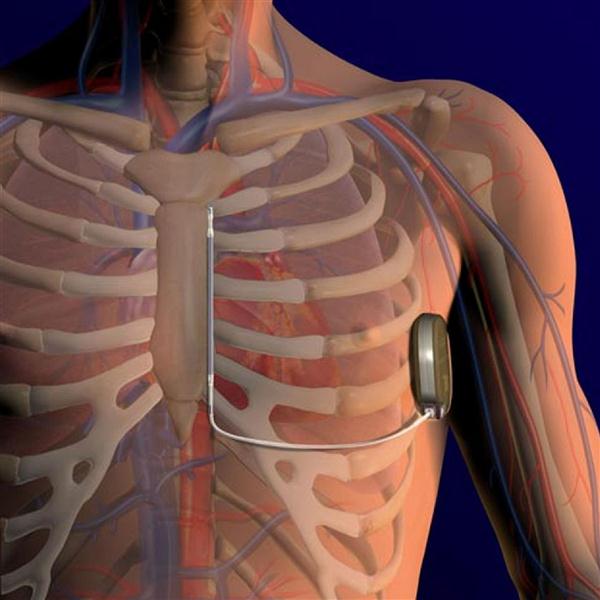 custom wiring and cable fabrication for internal defibrillators 